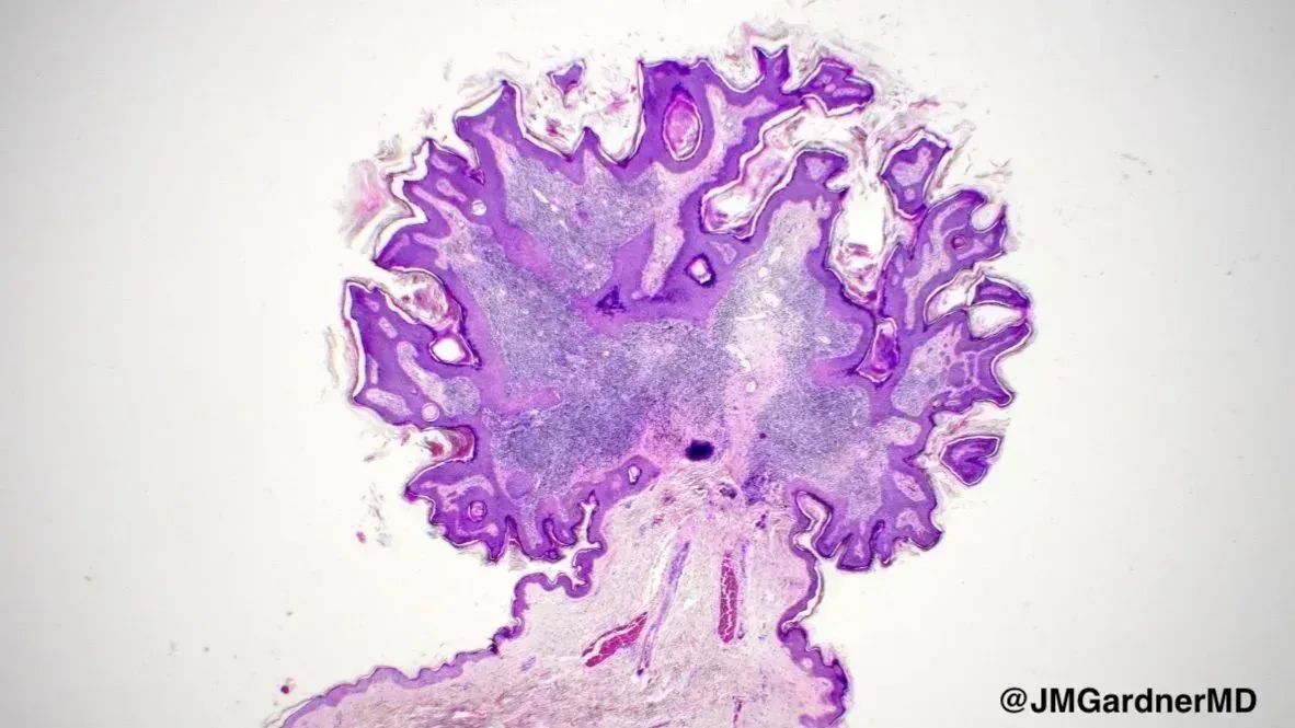 JMGardnerMD's tweet image. What would you call this lesion? Here's what I called it: youtu.be/248j6YXOy6o?si…. (PS - it looks like a bonsai tree to me!) #pathologists #pathTwitter #dermatology #dermatologia #dermtwitter