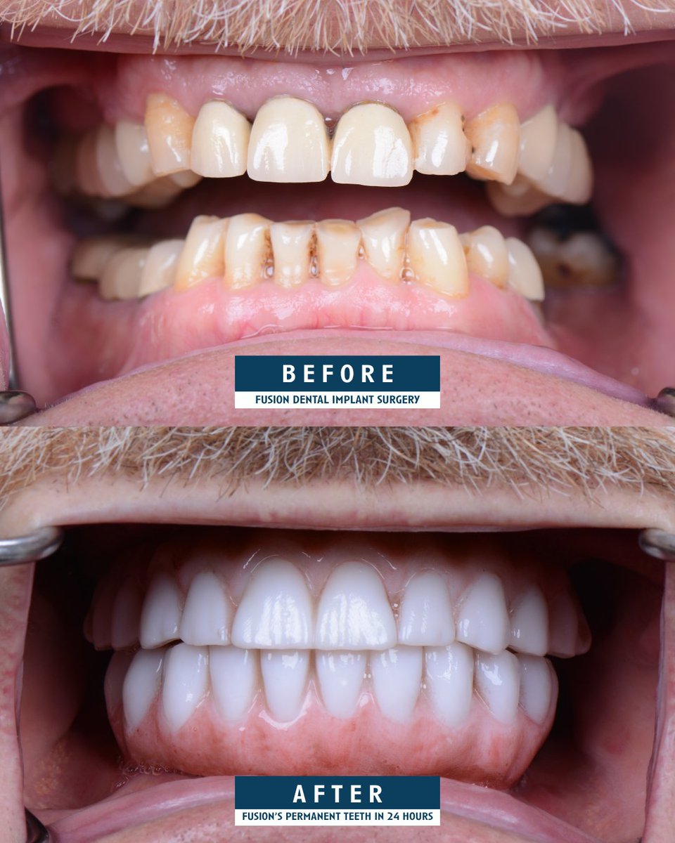 fusionfullarch's tweet photo. He found a permanent solution and is now enjoying life with strong, stable teeth. This can be you too. Schedule your complimentary consultation with Fusion today to explore your options and take the first step toward a confident, lasting smile. 🤩
#dentalimplantscostcalifornia https://t.co/fAvOEj9Gpe