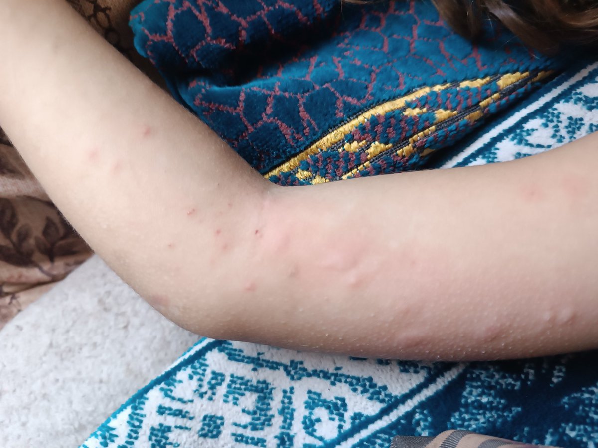 n_mohammedn's tweet photo. This is what mosquitoes have done to my little sister… Why does no one care about us? We are exhausted and can’t take it anymore. My family urgently needs a safe place to live. 💔 https://t.co/sdcZGNrJP1