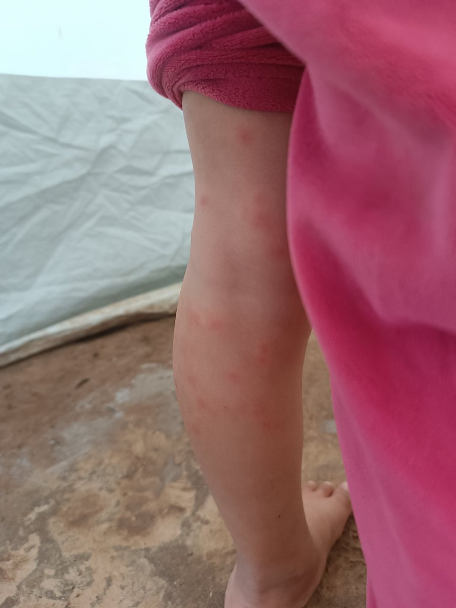 n_mohammedn's tweet photo. This is what mosquitoes have done to my little sister… Why does no one care about us? We are exhausted and can’t take it anymore. My family urgently needs a safe place to live. 💔 https://t.co/sdcZGNrJP1