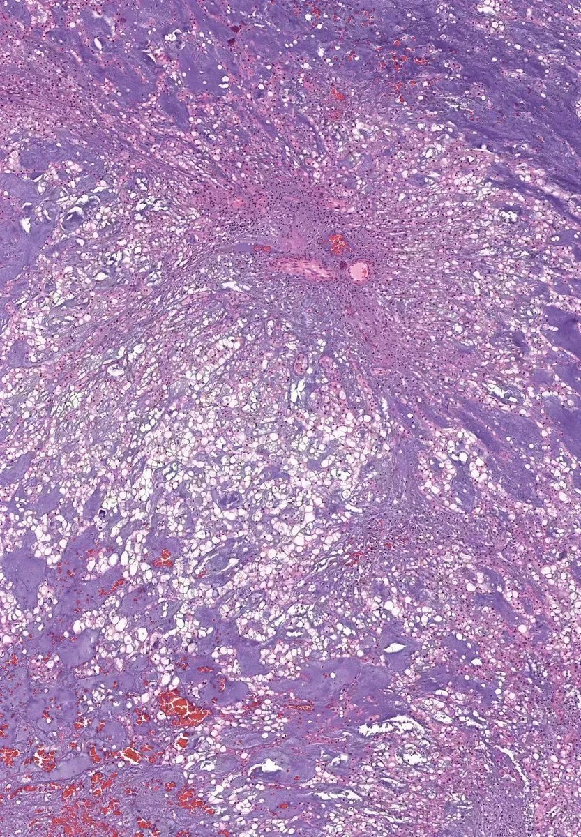 JMGardnerMD's tweet image. Sacral mass in adult. Diagnosis?
WSI digital slide: kikoxp.com/posts/20299
Answer ✅ youtu.be/vR5k9zjBlhg?si… 
Another great example: kikoxp.com/posts/8265
#neuropath #BSTpath #pathologists #pathology #pathTwitter