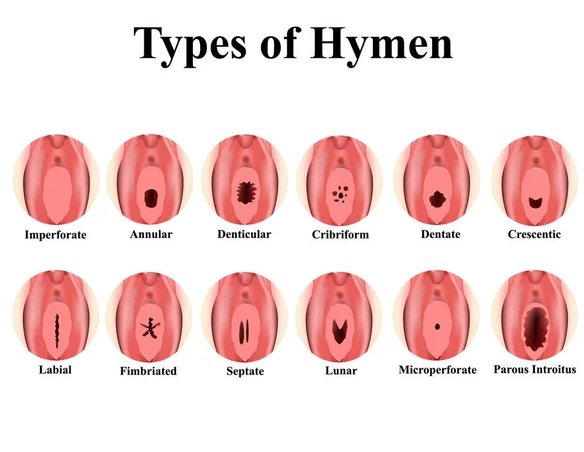 banyak cwk pengen perempuan "masih tersegel rapat" padahal kalau vagina benar-benar ketutup rapat tanpa lubang, cewe itu malah gak bisa menstruasi dan kemungkinan harus operasi

jadi selama ini yang kalian bangga-banggain soal "perawan asli segel utuh" itu literally kondisi medis