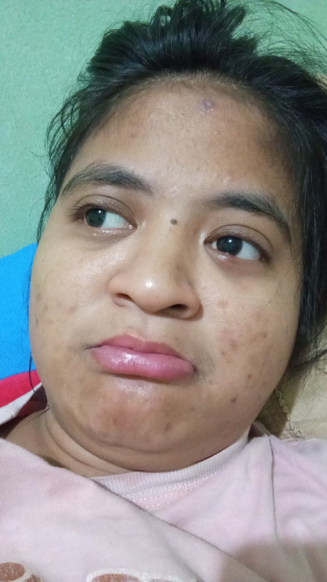 AnidaFCB's tweet photo. Gak pernah senangis ini grgr cantengan huhu sakit bngt nusuk ke daging nya itu loh sampe jalan pincang gini udh seminggu https://t.co/JNRxceYjU0