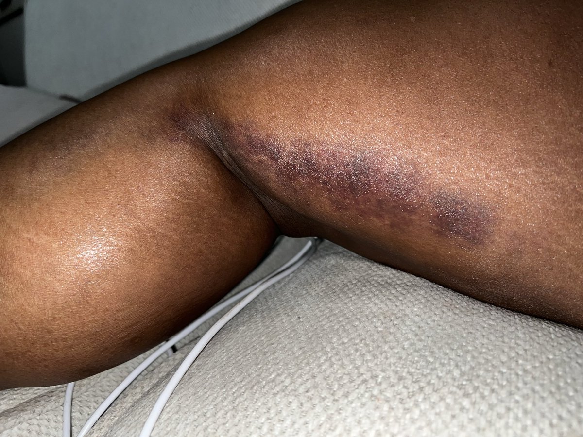 Chinfullthought's tweet photo. I end up banging up my knee. My left leg hurts, and there is a bruise on my right leg. A feature needs to be added so that when there is an impact, a notification pops up in the app asking if u need assistance, like 911. U should also be able to sync with your smart watch https://t.co/XQjRfDnvzc
