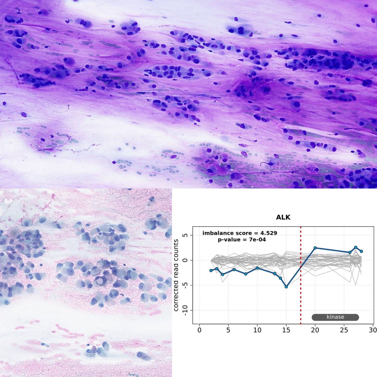 TJLynnMD's tweet image. This one clearly read the cytology and molecular textbooks… EML4::ALK fusion.
🧬🔬💉#cytology #molecular #NGS