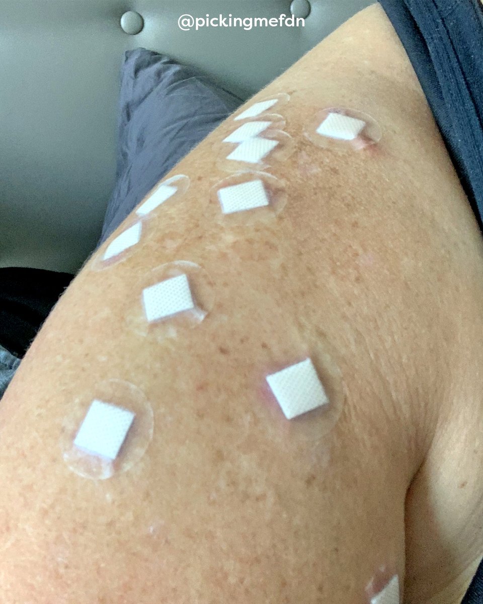 PickingMeFdn's tweet photo. Do you use hydrocolloid patches for your #SkinPicking management?

Our CEO @laurenmckeaney loves these as barriers for triggering bumpy areas, as well as for healing wounds!

Visit https://t.co/bd3mWs5BUq to learn more about Lauren's journey. https://t.co/bd5aSmcJKj