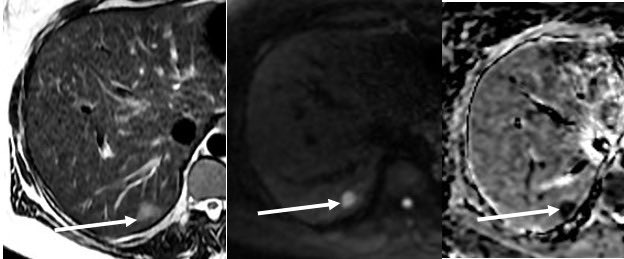 ElsayesKhaled's tweet image. Focal Hepatic Lesion in a patient with breast cancer. 
I will give an award for the correct answer and will post the correct  answer till later.

@ACOREdu @MedBlendPub 
 #MedicalEducation #Medblend #MedEd #radmeded #radiology #mentorship #coaching #residency #medstudent #IMG