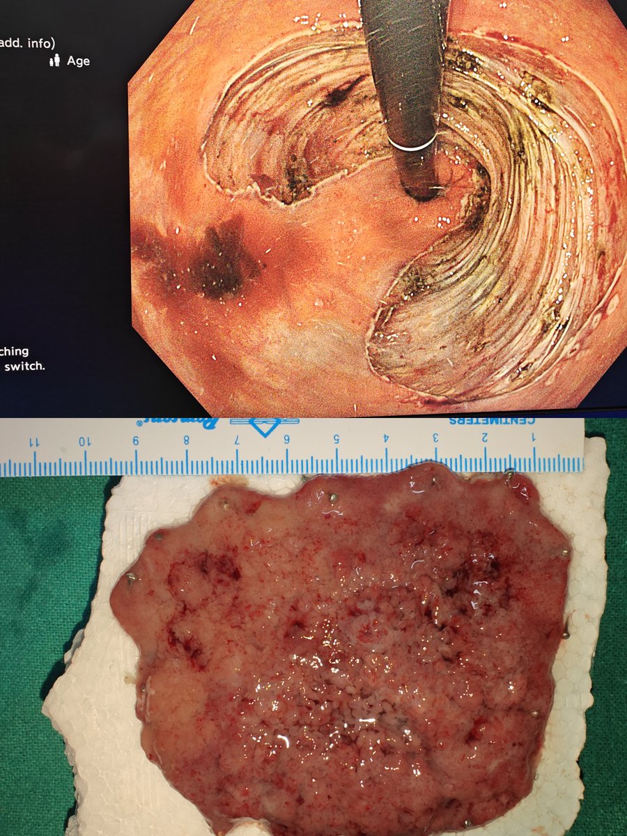 drashu123's tweet photo. Completed en bloc ESD for a large rectal LST (~10×10 cm, ~2/3rd circumference) at AIIMS Jodhpur. Procedure time: 6.5 hrs. Patient is stable.
Grateful for the excellent team effort. 🙏
#AdvancedEndoscopy #GI #AIIMSJodhpur https://t.co/tOFLe8md1g