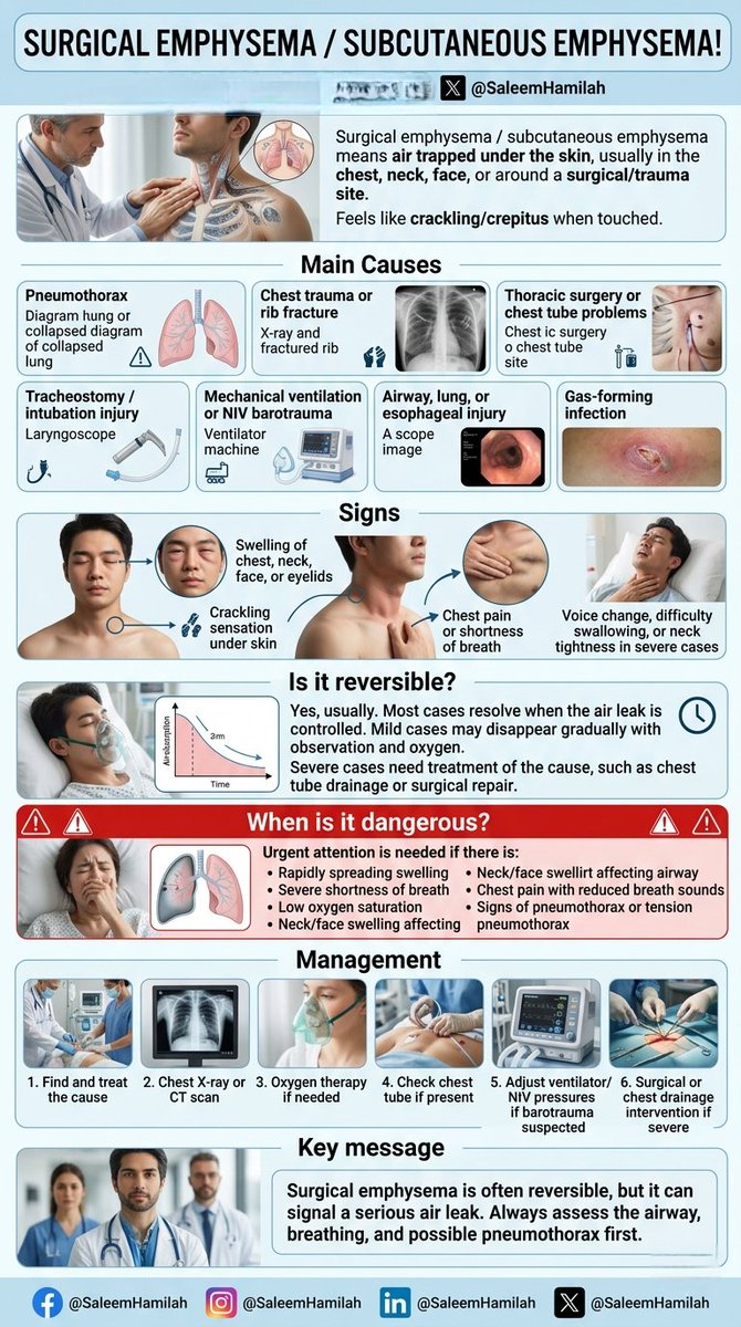 🤯🔶️ Surgical emphysema / subcutaneous emphysema!

✅️Surgical emphysema means air trapped under the skin, usually in the chest, neck, face, or around a surgical/trauma site. It feels like crackling/crepitus when touched.

 #subcutaneousemphysema #pneumothorax