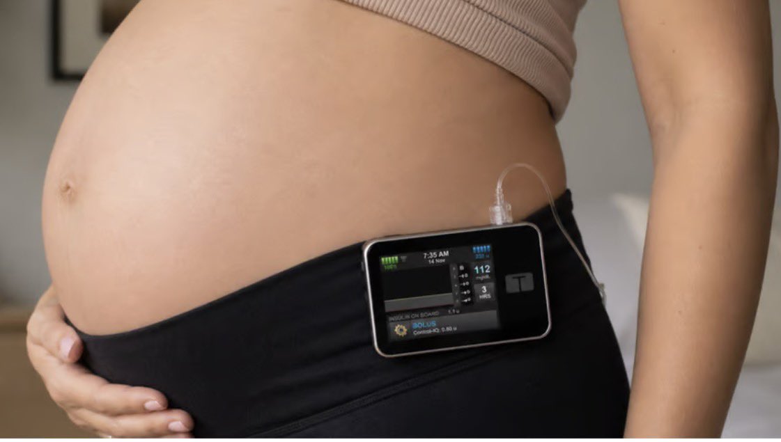 NorahAlobailly's tweet photo. خطوة مهمة في تقنيات السكري 👏🏻 🤰 

حصل نظام Control-IQ+ من شركة Tandem Diabetes Care على موافقة FDA للاستخدام أثناء الحمل لمرضى السكري من النوع الأول ليكون أول نظام AID معتمد لهذه الفئة في أمريكا.

مدعوم بنتائج دراسة CIRCUIT (JAMA 2025):
• تحسين الوقت ضمن النطاق (TIR)
• تقليل الارتفاعات والانخفاضات
• تحسن سريع ومستمر