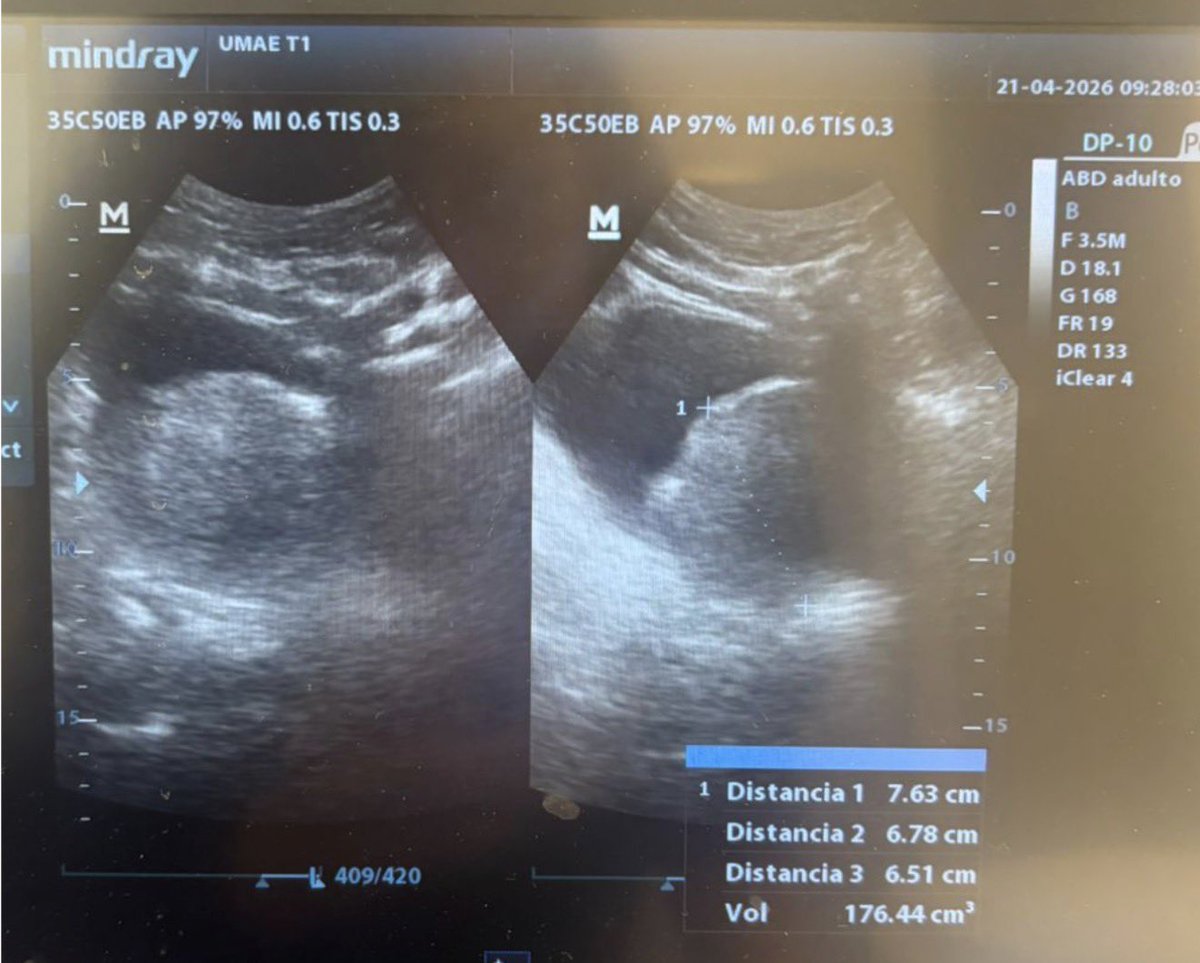 PulidoUro's tweet photo. #BipolEP
Prostate: 170gr
✅ Smooth rotational movements of the external sheath create a beautiful, well-defined enucleation plane
✅ Excellent coagulation
✅ Feasible and easy using the Button Loop https://t.co/NhKN5DG4HM