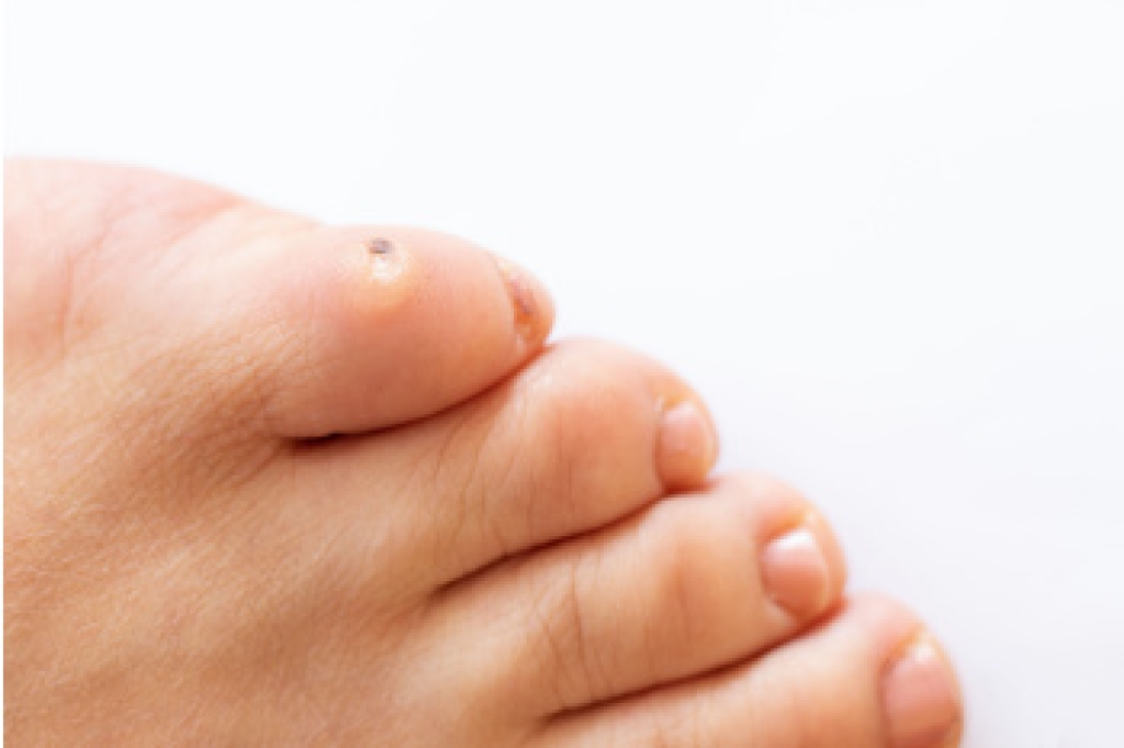 Elite_Podiatry's tweet photo. Understanding Foot Corns and How to Manage Them https://t.co/JRi8E5WPHD https://t.co/5xu9pSpDsI
