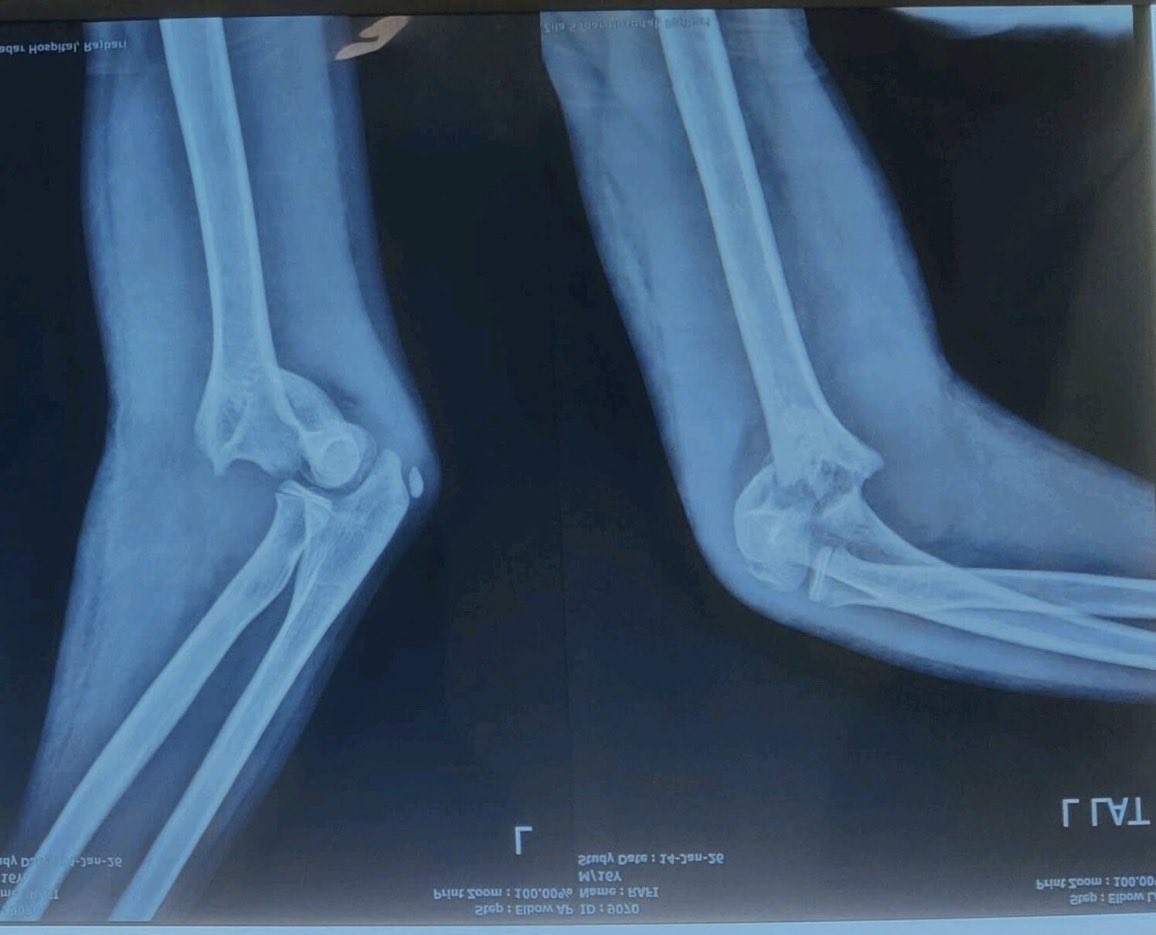 DennisGodsmark's tweet photo. X-ray images of a 13-year-old child.

What is your provisional diagnosis???
Recommended treatment? https://t.co/ekxeToDNCO