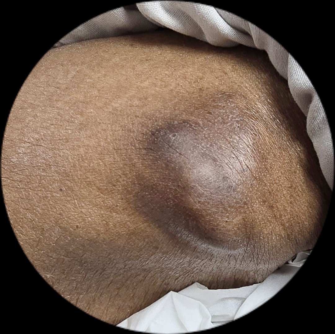SyedSal55391459's tweet image. #pathX
#pathTwitter
#Quiz
60-yr. F
Hard subcutaneous  nodular lesion of waist.
Patient sent for FNAC.
What is your impression?