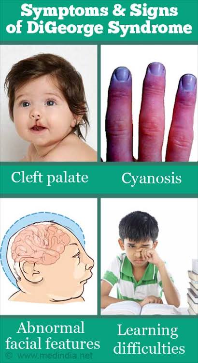 MedicalMnemonik's tweet photo. Topic: Pediatrics / Cardiology

👉 Most common CHD with DiGeorge syndrome is TOF

Subtopic: DiGeorge Syndrome

Mnemonic Type: Wordplay

Mnemonic: 2 George = 4 Fallot

DiGeorge syndrome → “2 George”

→ 4 = Tetralogy

→ Tetralogy of Fallot 💙 https://t.co/EKIsgqSLR5