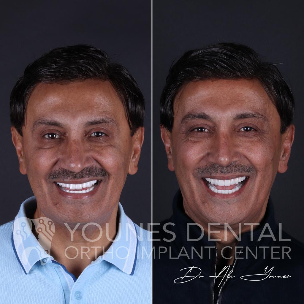 Dr_Ali_Younes's tweet image. من الكويت 🇰🇼 إلى لبنان 🇱🇧، للحصول على ابتسامة احلامه😁
فقد الأمل من بعد ما شاف كتير دكاترة بالكويت، قالولو حالتك كتير صعبة و ما عندك عضم، حصل على ابتسامة أحلامه بمراكزنا بلبنان 
 Yones Dental Clinic
+96181258176 
#DentalImplants #Smilemakeover  #Dentistry #DrAliYounes