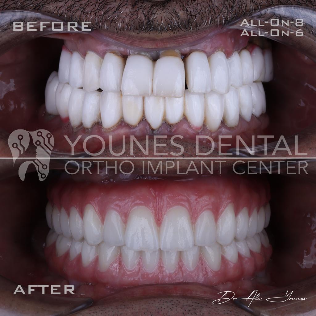 Dr_Ali_Younes's tweet image. من الكويت 🇰🇼 إلى لبنان 🇱🇧، للحصول على ابتسامة احلامه😁
فقد الأمل من بعد ما شاف كتير دكاترة بالكويت، قالولو حالتك كتير صعبة و ما عندك عضم، حصل على ابتسامة أحلامه بمراكزنا بلبنان 
 Yones Dental Clinic
+96181258176 
#DentalImplants #Smilemakeover  #Dentistry #DrAliYounes