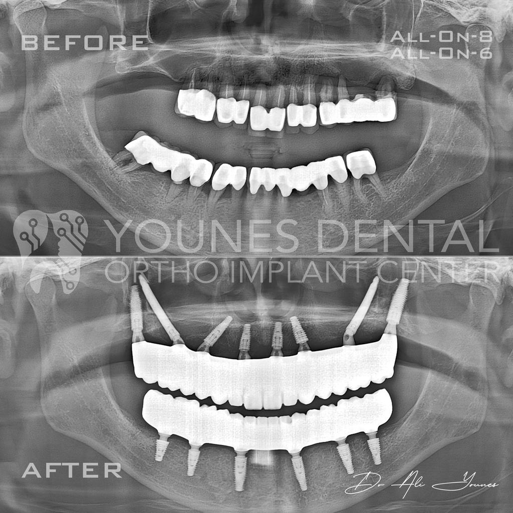 Dr_Ali_Younes's tweet image. من الكويت 🇰🇼 إلى لبنان 🇱🇧، للحصول على ابتسامة احلامه😁
فقد الأمل من بعد ما شاف كتير دكاترة بالكويت، قالولو حالتك كتير صعبة و ما عندك عضم، حصل على ابتسامة أحلامه بمراكزنا بلبنان 
 Yones Dental Clinic
+96181258176 
#DentalImplants #Smilemakeover  #Dentistry #DrAliYounes