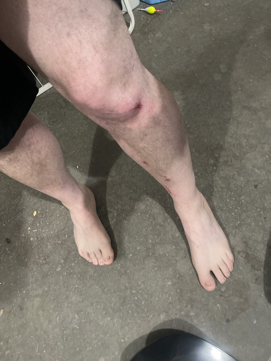 BenjiButtons_'s tweet image. 🚨GRAPHIC WARNING! 🚨

God had my back this past weekend. I fell through a sewer grate  on our property. My knee cap “caught me”. This is the aftermath. 

#Thankful #Blessed