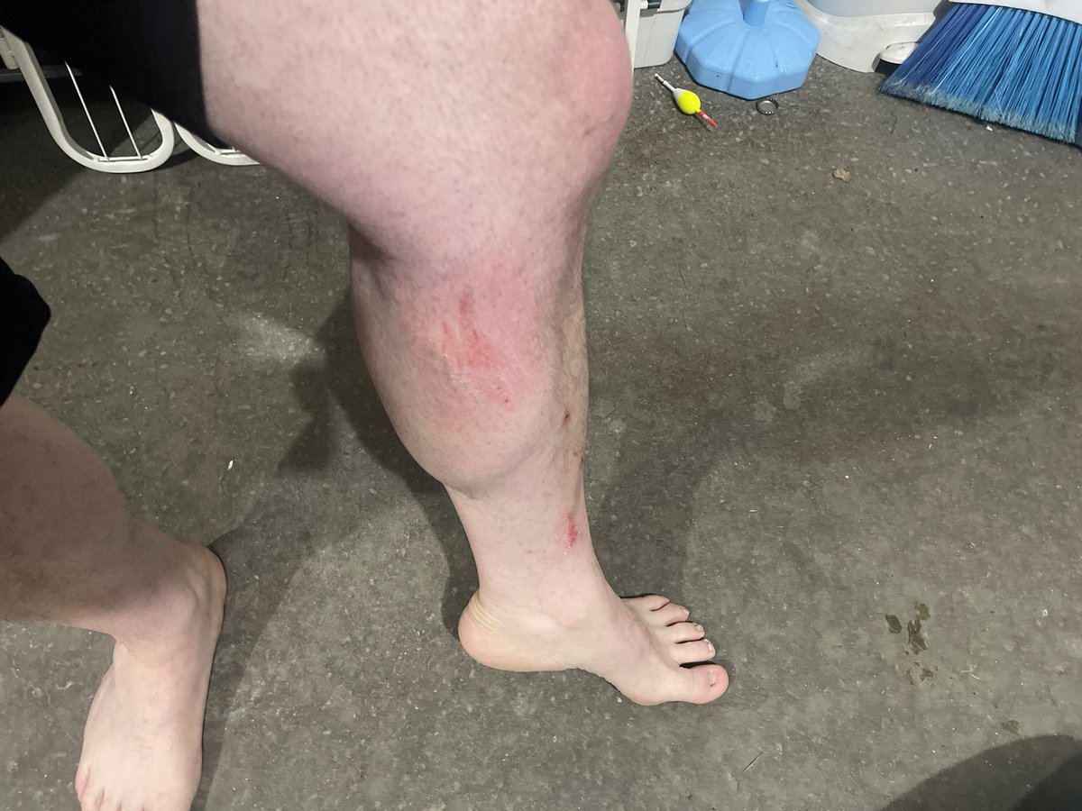 BenjiButtons_'s tweet image. 🚨GRAPHIC WARNING! 🚨

God had my back this past weekend. I fell through a sewer grate  on our property. My knee cap “caught me”. This is the aftermath. 

#Thankful #Blessed