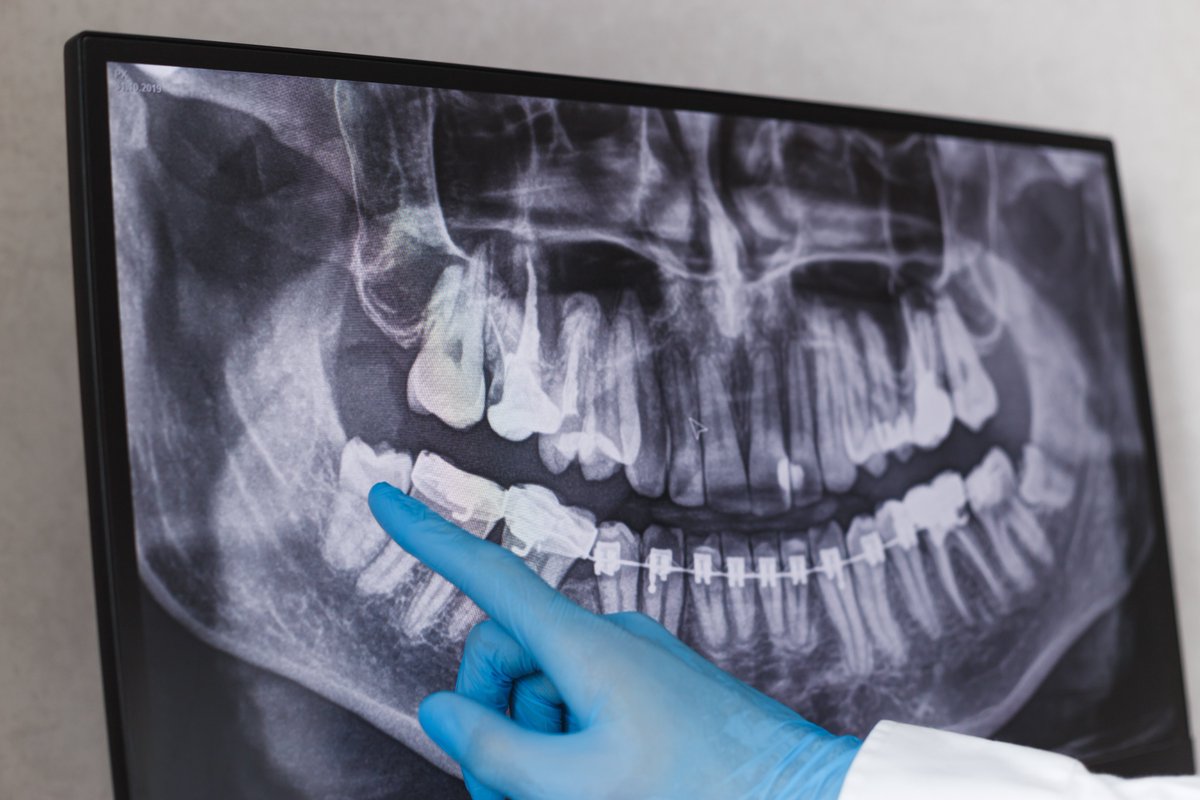 AutumnDentalGA's tweet image. Removing wisdom teeth at a younger age can make the process easier and recovery smoother.
As wisdom teeth develop, their roots continue to grow and the bone around them becomes denser.
That's why routine x-rays and evaluations are so important!

#autumndental #tuesdaytip