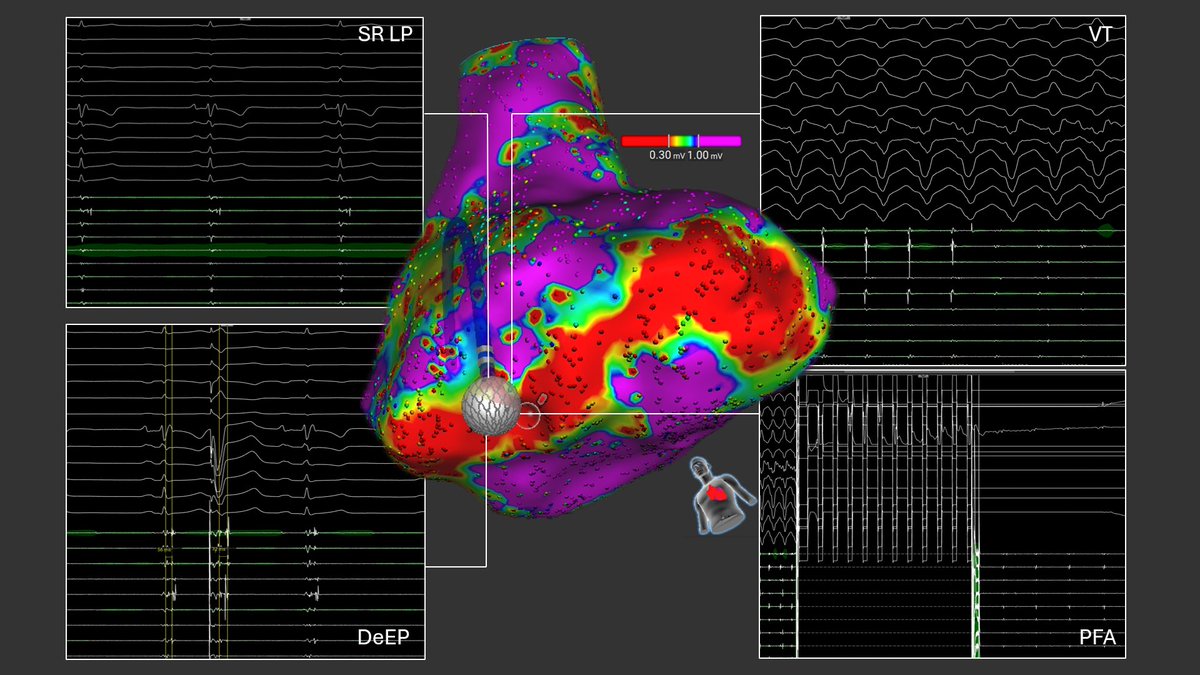 MEfraimidis's tweet photo. DeEP and activation mapping identified the critical isthmus in a patient with ARVC. PFA delivery terminated the VT and rendered it non-inducible.
 @SteliosDragasis @ipetemil @Kariki_O @athsaplaouras  @K_Letsas @koskinastavrina @PetrosSkalidis #Onassis Hospital #Affera https://t.co/KJEfzDGcar