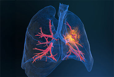 ClinOncNews's tweet image. 📈 Lung cancer survival is improving.
5-year survival has risen to ~27–28%, up from 15–17% in the 1990s—thanks in part to targeted therapies and immunotherapy: clinicaloncology.com/a/RDgBAA/t
#LungCancer #Oncology