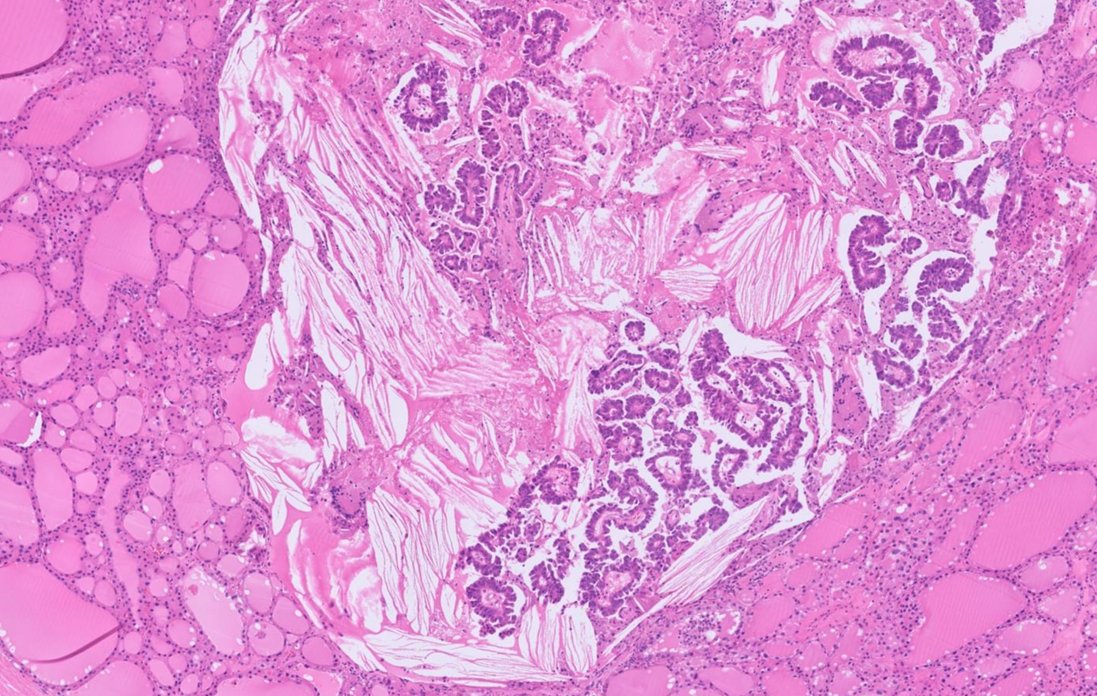 Janiranavarro's tweet photo. Metastasis to thyroid -Common Pitfalls

- Metastatic RCC misdiagnosed as primary follicular neoplasm
- Metastatic well-differentiated adenocarcinoma as papillary thyroid carcinoma, for example metastatic lung adenocarcinoma (see pic 2-4)
- Metastatic high grade carcinoma as poorly differentiated thyroid carcinoma (PDTC) or anaplastic thyroid carcinoma 

Dr. Hang #USCAP2026 #pathology #PathX #PathTwitter