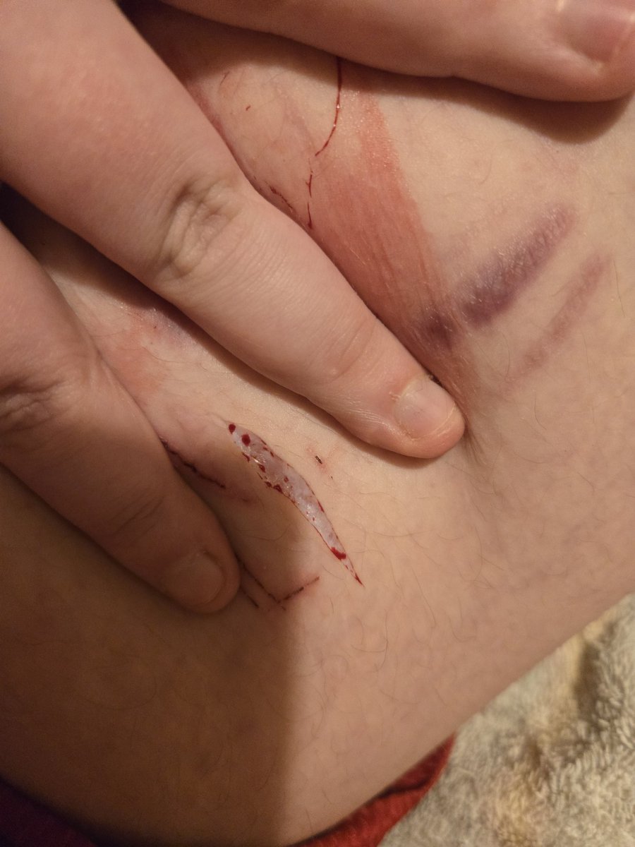 flimflam44's tweet photo. I keep getting the most babiest of beans and its driving me nuts. These hurt so much worse than just straight beans idk why but augghrbsjfbebdf they sting 😭😭 https://t.co/Q5yc7uC7pL