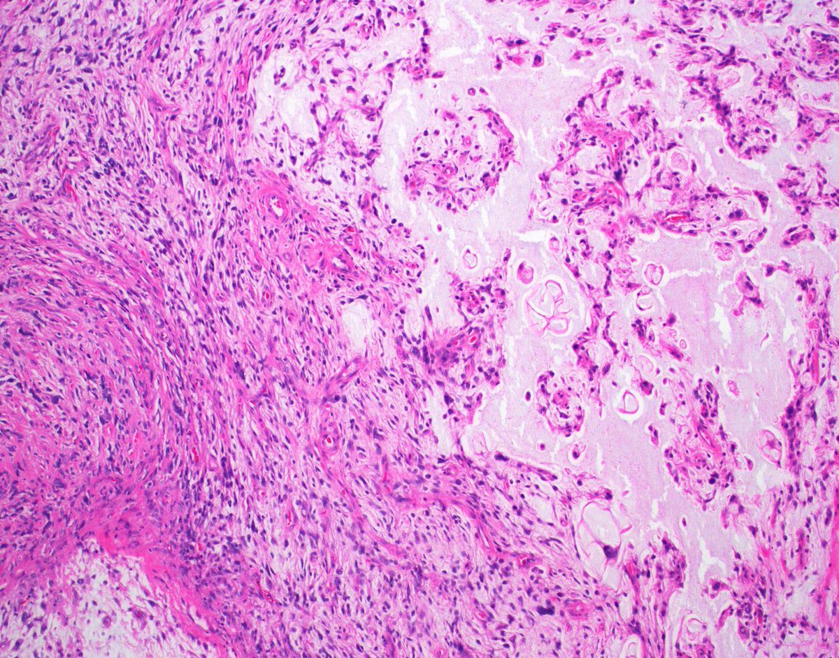 JMGardnerMD's tweet image. Thigh mass in elderly adult. Diagnosis? (hint: it's NOT liposarcoma)
Answer ✅  youtu.be/LTHBkzxbgj0?si… 
More pics &amp;amp; info =&amp;gt; kikoxp.com/posts/14352
#BSTpath #pathology #pathologists #pathTwitter #dermpath #dermatology #dermatologia #dermtwitter
