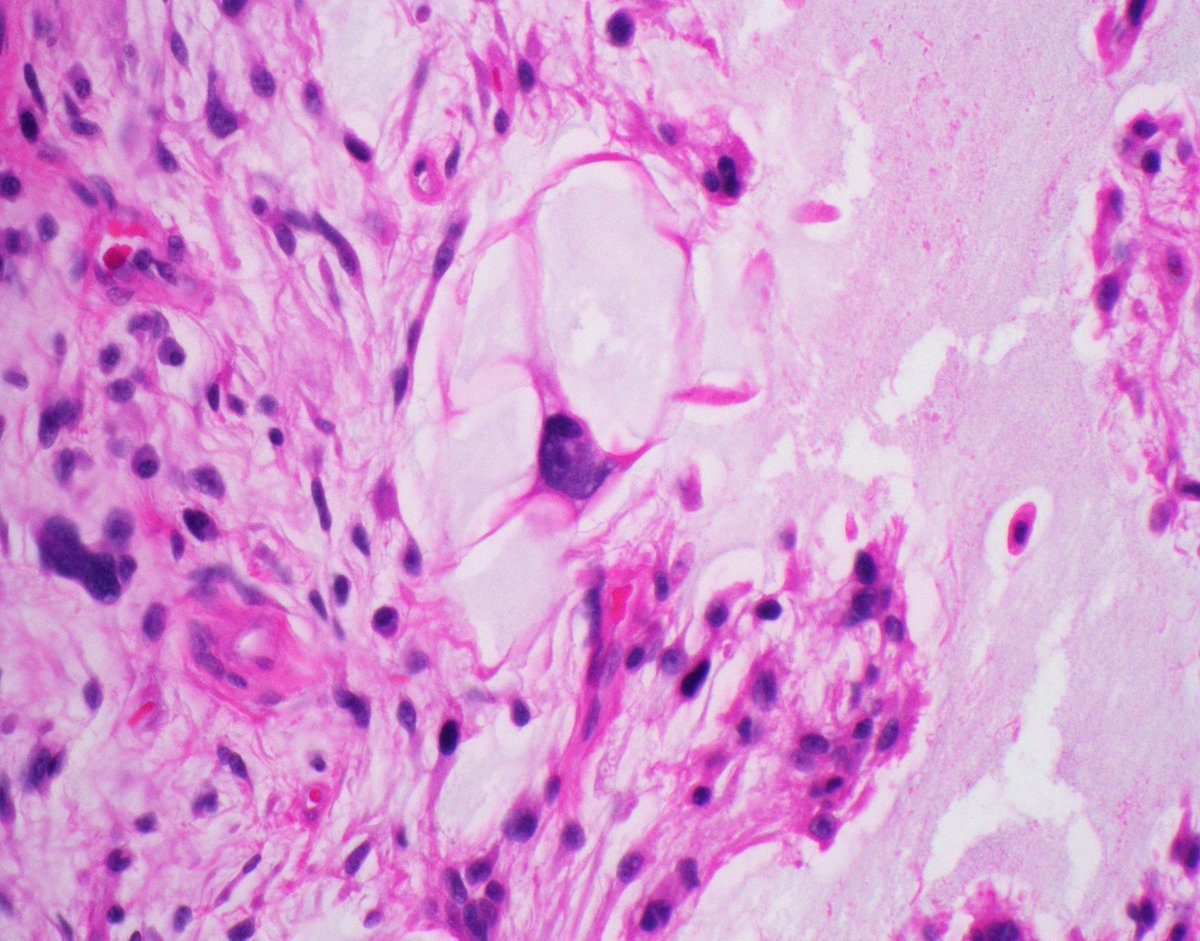 JMGardnerMD's tweet image. Thigh mass in elderly adult. Diagnosis? (hint: it's NOT liposarcoma)
Answer ✅  youtu.be/LTHBkzxbgj0?si… 
More pics &amp;amp; info =&amp;gt; kikoxp.com/posts/14352
#BSTpath #pathology #pathologists #pathTwitter #dermpath #dermatology #dermatologia #dermtwitter