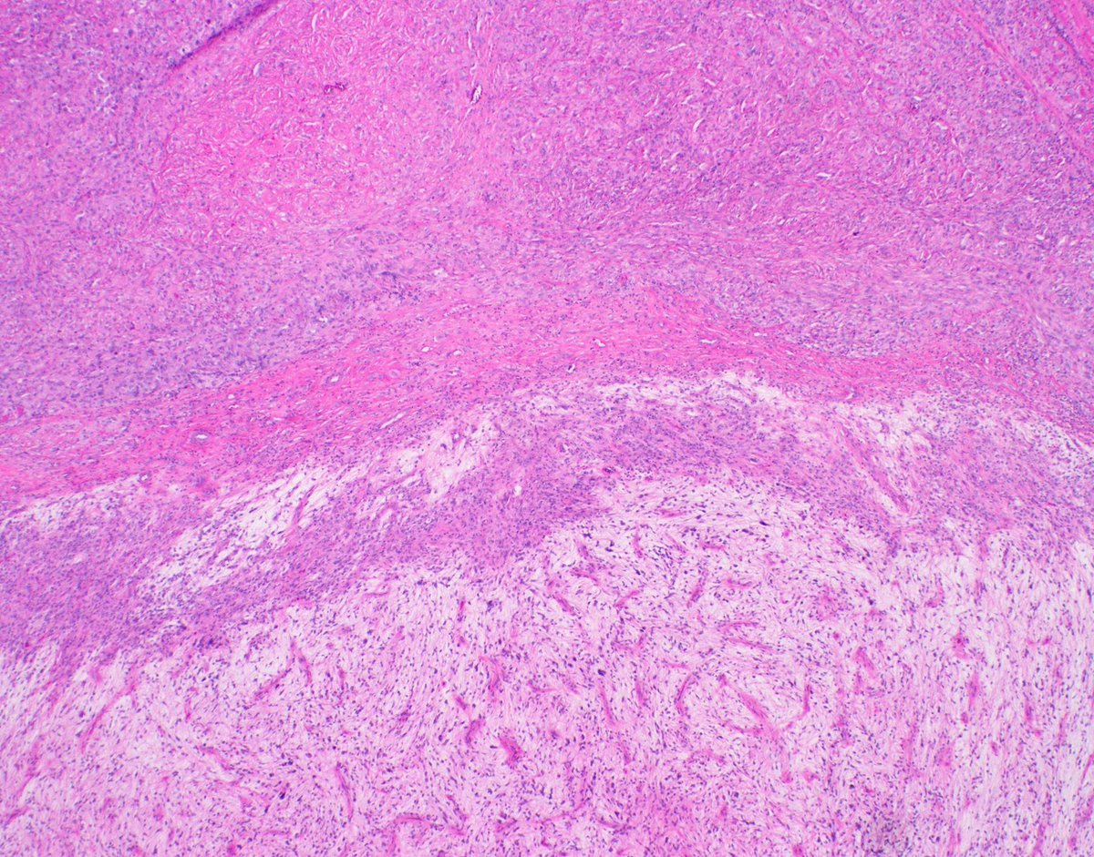 JMGardnerMD's tweet image. Thigh mass in elderly adult. Diagnosis? (hint: it's NOT liposarcoma)
Answer ✅  youtu.be/LTHBkzxbgj0?si… 
More pics &amp;amp; info =&amp;gt; kikoxp.com/posts/14352
#BSTpath #pathology #pathologists #pathTwitter #dermpath #dermatology #dermatologia #dermtwitter