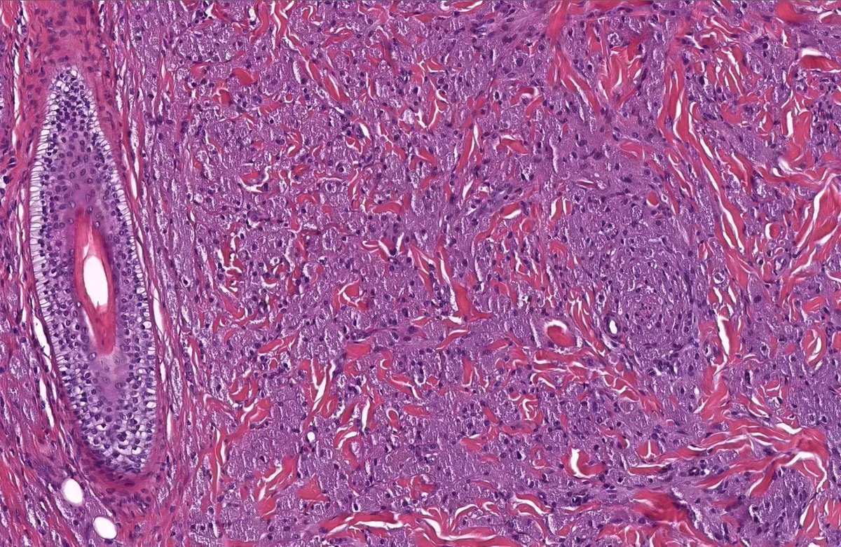 JMGardnerMD's tweet image. Back nodule. Diagnosis?
Answer ✅ youtube.com/watch?v=brS4__… 
Similar case (wow!)🔬kikoxp.com/posts/8186 
Videos ⏯️ kikoxp.com/posts/11641 &amp;amp; kikoxp.com/posts/4550 &amp;amp; kikoxp.com/posts/4617 
#BSTpath #pathology #pathologists #pathTwitter #dermpath #dermatology #dermtwitter