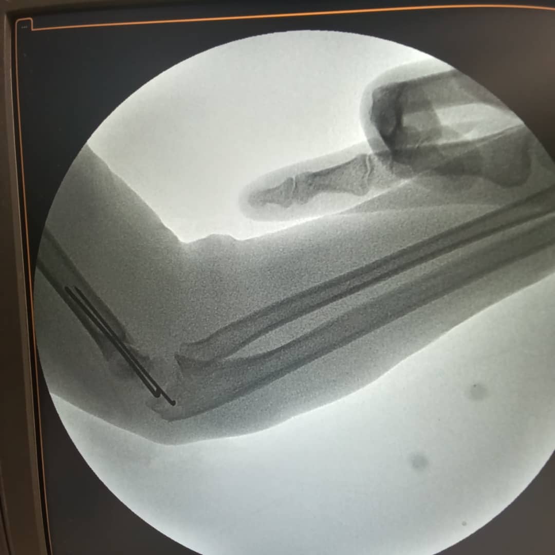 EMsllate's tweet photo. Girl 7 yrs old Sustained closed fracture  supracondylar humerus  
Operated by CRPP k-wires 

🙌 https://t.co/mIj39uT47p