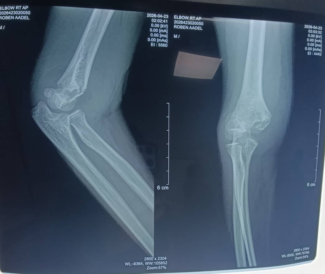 EMsllate's tweet photo. Girl 7 yrs old Sustained closed fracture  supracondylar humerus  
Operated by CRPP k-wires 

🙌 https://t.co/mIj39uT47p