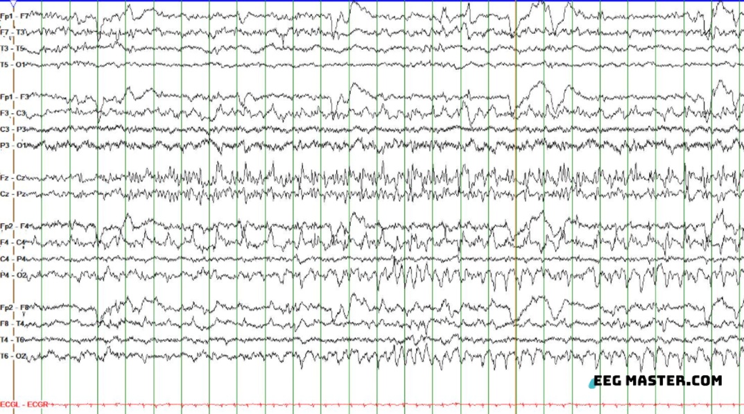 eeg_master's tweet photo. 1-day-old born at 40 wks gestation underwent cEEG. Based on the following, what is most likely seizure semiology?

A) Right arm clonic
B) Left arm clonic
C) Bilateral tonic
D) Behavioral arrest/lip smacking
E) Generalized Myoclonus

Select your answer at https://t.co/ev53PtoF2d https://t.co/EhWTREn4B9