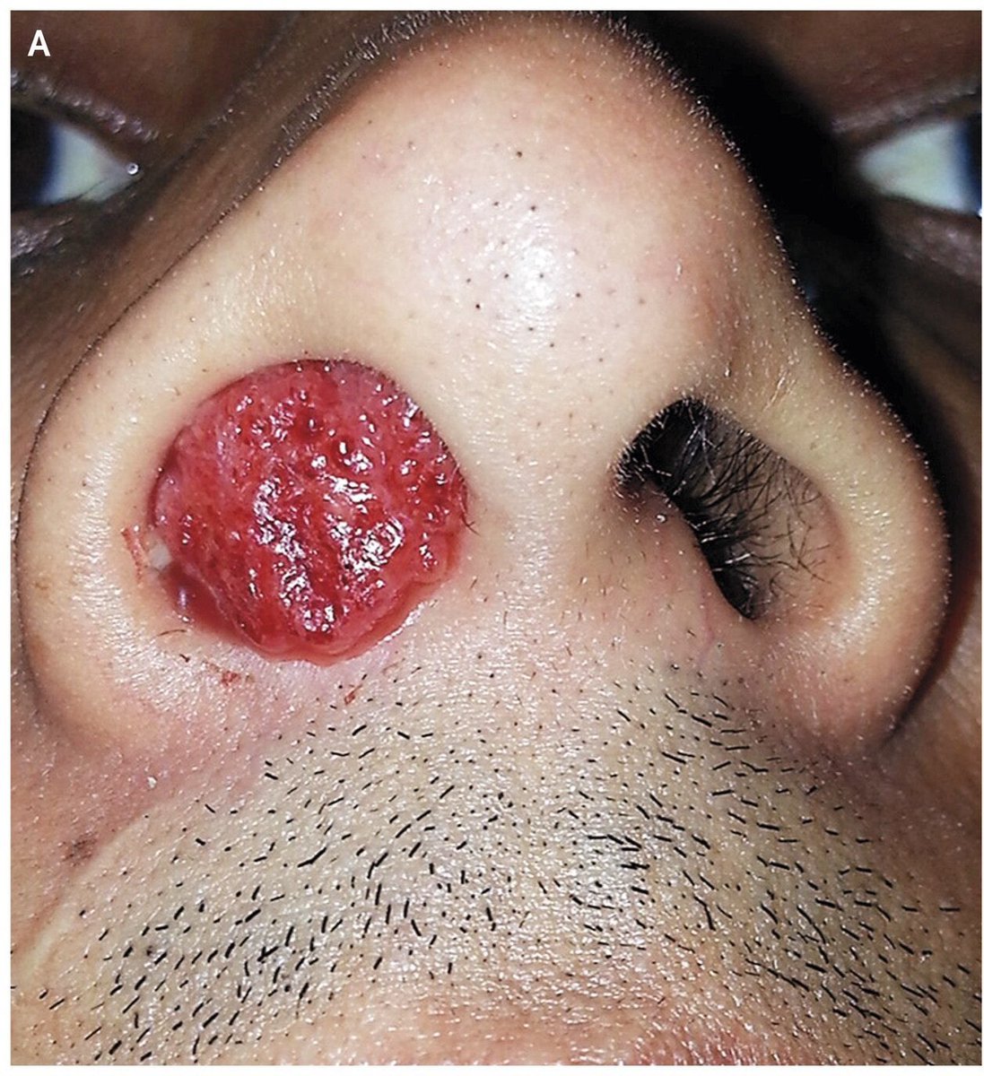 hemo_shk's tweet image. That's a strawberry in the nose!

Diagnosis?