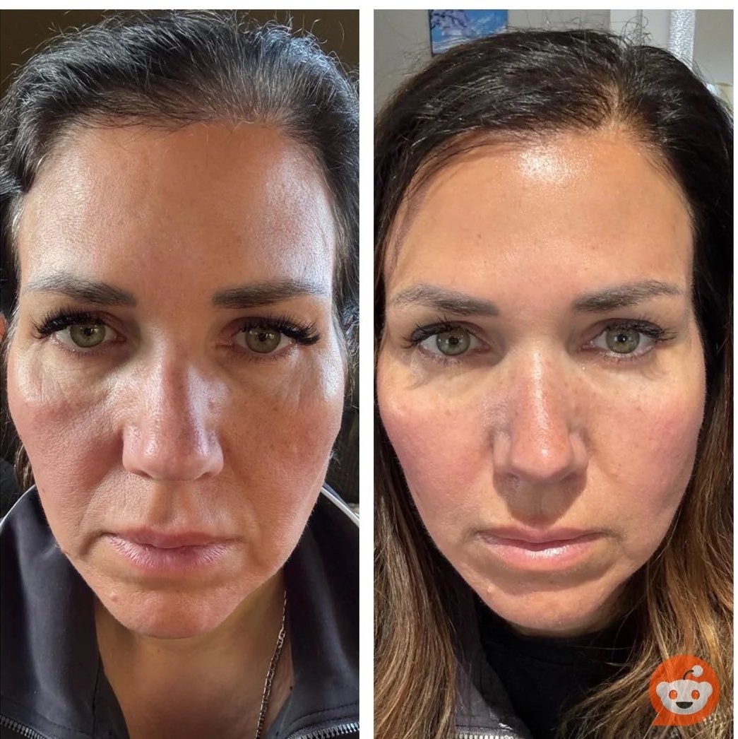 peptidelab2's tweet image. Ghk cu results so far! 💕

This is only 3 weeks of using ghk cu 1 mg 5 days a week, also she added it to her tallow cream that she use daily. No filers 

She’s 55 yrs old 

#peptides #Ghkcu #weightloss