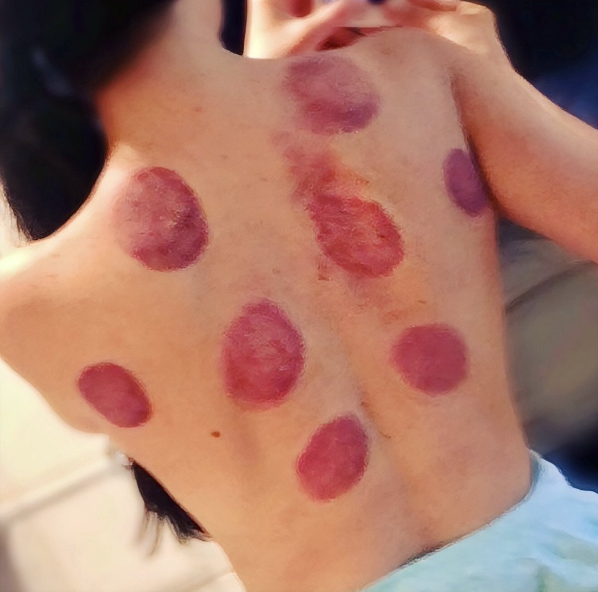 tatvonb's tweet image. This is how bad my back is. Ffs 20 years of hard work and being active 🥴 ffs growing old ain’t for the faint hearted 🤣 #gymrat #work #painmanagement #bishimsore