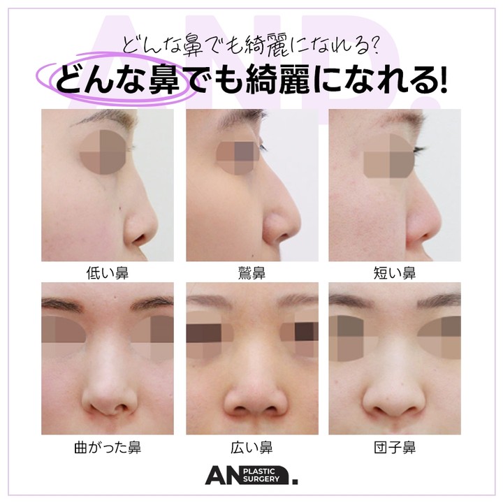 韓国🇰🇷👃🏻鼻専門医👃🏻AND(エンド)整形外科 tweet media