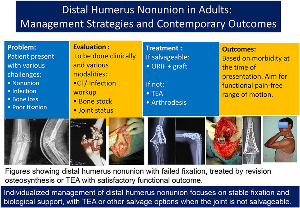 journal_trauma's tweet image. Distal Humerus Nonunion in Adults: Management Strategies and Contemporary Outcomes - Journal of Clinical Orthopaedics &amp;amp; Trauma
#Orthopaedics #Trauma journal-cot.com/article/S0976-…