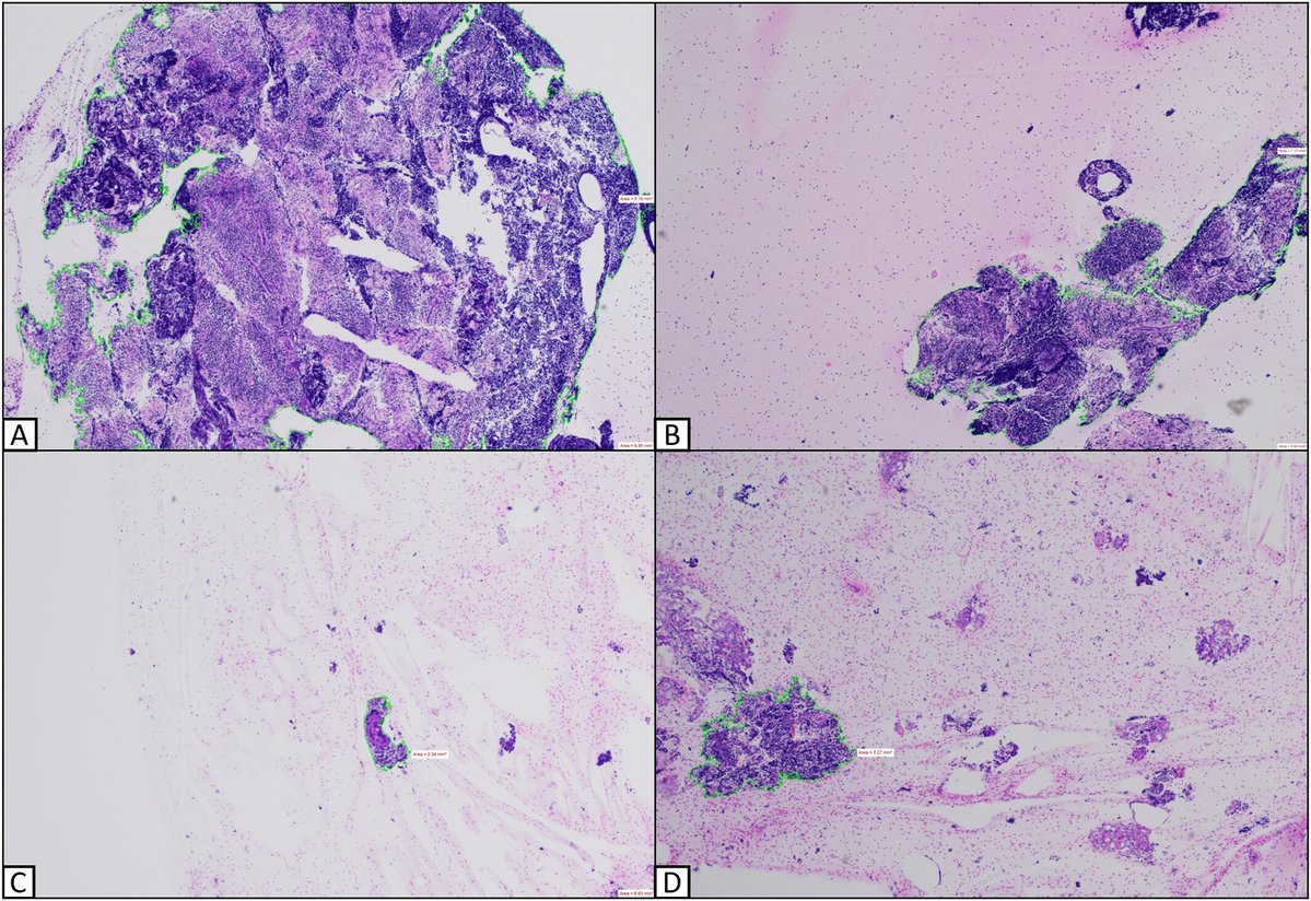 CancerCytopath's tweet image. Free access🔬 | Comparison of conventional and novel rotational FNA needles using conventional microscopy and image analysis to quantitatively assess yield

acsjournals.onlinelibrary.wiley.com/doi/full/10.10…

#CytoPath @SMonaco3