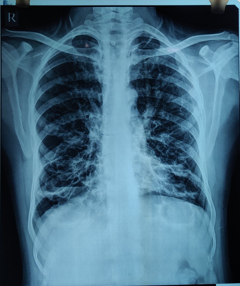 bisu439's tweet image. 📝40 yr old Male admitted with Productive cough for 6 years and Breathlessness for 1 months which has increased over last 1 week , Fever for 1 week.
👉🏻 What do you find in the CXR? 
#Medicine #MBBS #NeetPG #Respiratory 
(Answer will be posted tommorow)