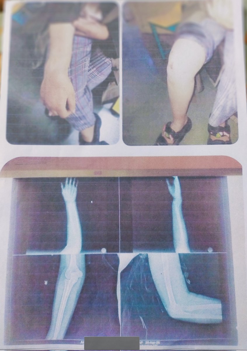 themaskeddoc's tweet photo. @NTA_Exams @NTA_Exams 
Met with a hit-and-run accident and have suffered a both bone forearm fracture of right forearm  Due to this, I am unable to write properly.

I have already emailed NTA multiple times with requesting a scribe for NEET UG but have not received any response yet. https://t.co/IWtcU0F2EZ