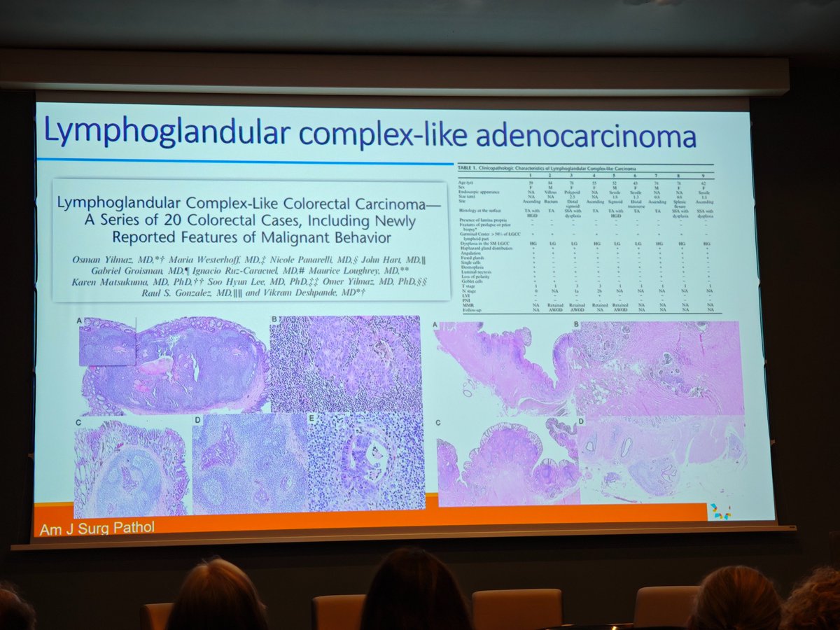 MirunaPopescu13's tweet photo. Mimics of invasion in colorectal polyps ➡️ adenoma fragments falling through defects in the musc.muc. in areas of lymphoid aggregates (lymphoglandular complex)
🚨Disceiving when the herniating area has HG dysplasia
DDx: lymphoglandular complex-like adenoCA (new WHO6th)

Dr. Rish Pai, #HMAR_DIGESTIVE26
#GIPath #PathTwitter