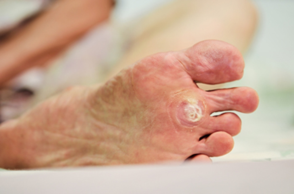 DrAlanSpector's tweet photo. Understanding Plantar Warts and Treatment Options https://t.co/5PlBRZ2MMh https://t.co/49lRCIfGrP
