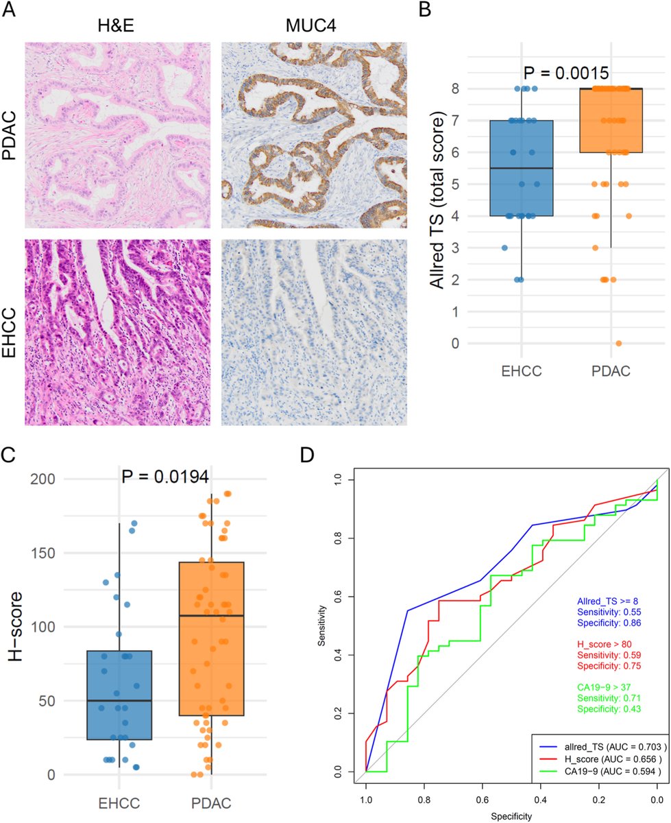 Human_Pathology's tweet image. New in #HumPathol: Diagnostic Utility of MUC4 Expression for Distinguishing Pancreatic Ductal Adenocarcinoma from Extrahepatic Cholangiocarcinoma and Its Clinicopathological Significance. sciencedirect.com/science/articl… #pathology #PathTwitter #PathX #GIpath #pancpath