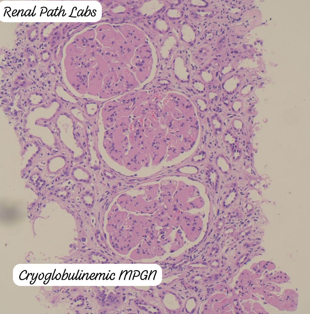 RenalPathLabs's tweet photo. Two Cryoglobulinemic GN within 10 days!
One showing microtubules on EM.
Rare are not rare in Indian subcontinent?
..

#RenalPath #Nephtwitter #PathTwitter #KidneyBiopsy #Nephpath #CryoglobulinemicGN
@AskRenal https://t.co/qKjKlerS4O