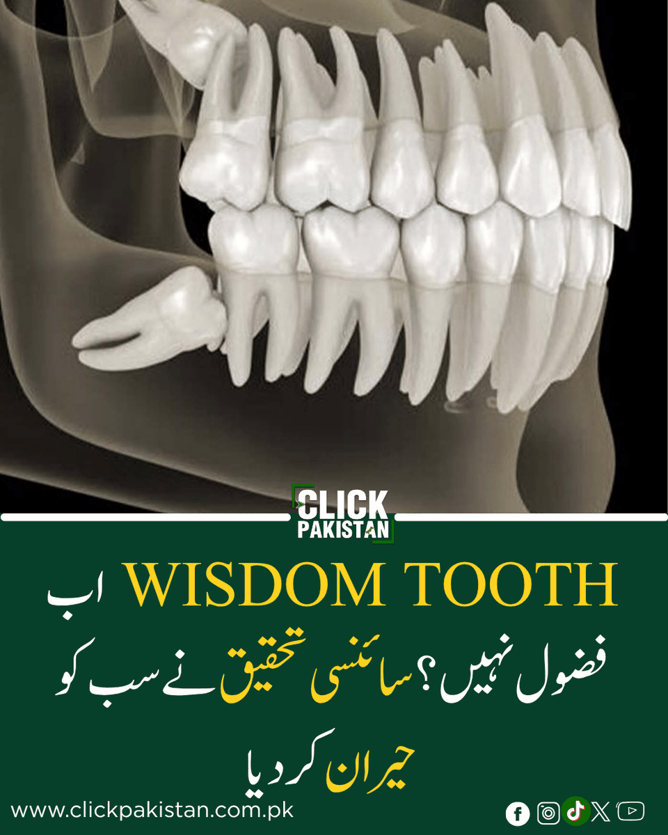 ClickPakistan1's tweet image. Wisdom Teeth No Longer “Useless”? New Scientific Discovery Could Change Modern Medicine
Link: clickpakistan.com.pk/wisdom-teeth-n…
#WisdomTeeth #StemCells #MedicalBreakthrough #HealthScience #FutureMedicine