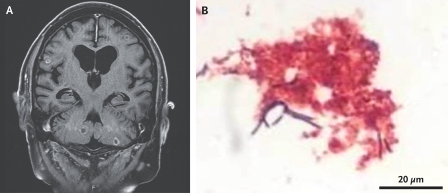 guerreroespejo's tweet image. An 80-y-o ♂️treatment for multiple myeloma: 2-week history of low-grade fevers, obtunded

MR: multiple ring-enhancing lesions (A)

CSF: 923 nucleated cells/μL ( 91% neutrophils), glucose 36 mg/dl, protein 147 mg/dl.

CSF culture (B): ?
1/2

DOI: 10.1056/NEJMicm2104629
#IDX #MedEd